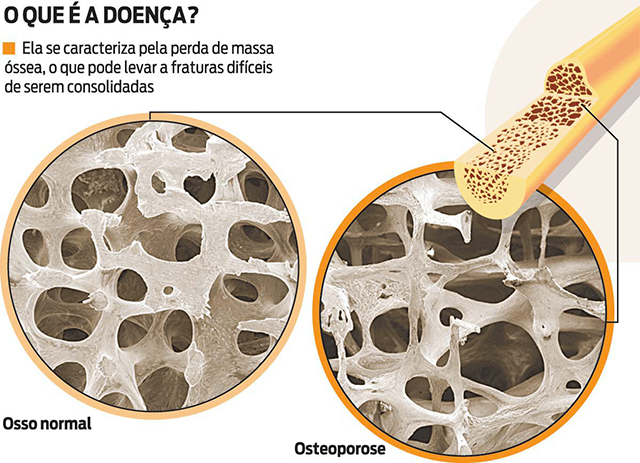 Infográfico "O que é a doença?", sobre a osteoporose: ela se caracteriza pela perda de massa óssea, o que pode levar a fraturas difíceis de serem consolidadas. Duas microfotografias circulares comparam o tecido ósseo. À esquerda, rotulada "Osso normal", a trama é densa e os espaços entre as traves são pequenos. À direita, rotulada "Osteoporose", a mesma trama aparece rarefeita, com traves finas e espaços vazios muito maiores. Ao alto, o desenho de um osso longo em corte mostra de onde vem a amostra ampliada.